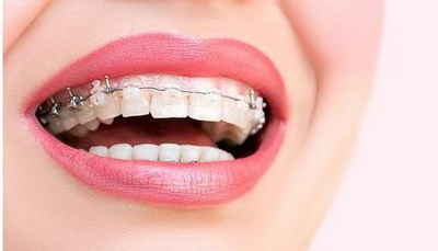 牙齿怎么会有裂缝