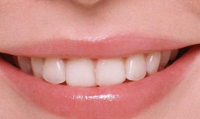 西安根管治疗带牙套(牙套影响根管治疗效果？)