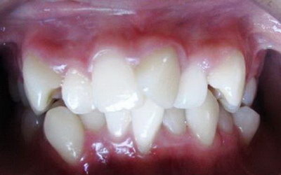 牙齿破损导致敏感