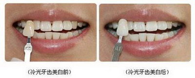 树脂假牙制作过程(树脂假牙的制作过程)