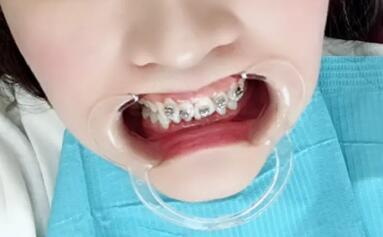 小孩牙齿表面出现小坑的症状(小孩牙齿表面出现小黑点)