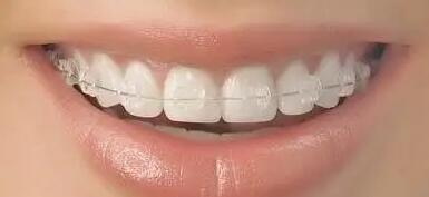 牙齿美白价格怎么样啦？