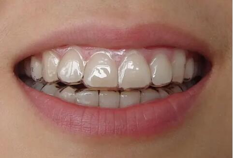 全瓷牙会牙髓炎吗(全瓷牙是否会导致牙髓炎？)