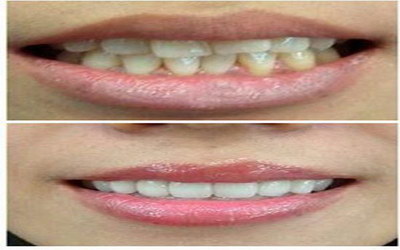 牙齿牵引成功的整个过程步骤_牙齿破损修复可以做吗