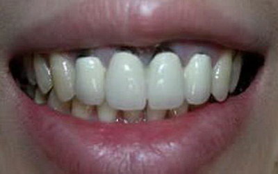 牙体修复材料(牙体修复材料的选择原则)