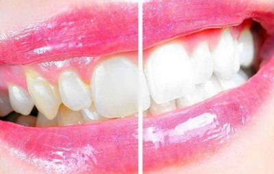 做过根管治疗的牙齿出血_做根管治疗后可以刷牙吗