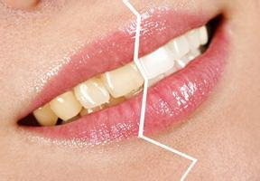 牙龈萎缩洗牙后牙龈还会好吗「洗牙后牙龈萎缩没了」