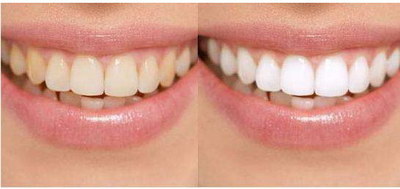 怎样区别智齿牙和大牙