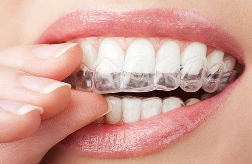 做牙齿有几种方法「美容牙齿有几种方法矫正」