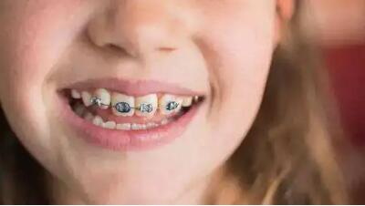 牙齿矫正从什么年龄合适「牙齿矫正什么年龄都行吗」