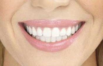 牙齿美白活动广告宣传语_南京牙齿美白公司