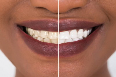 健康的牙齿标准_健康的牙齿拍片图片