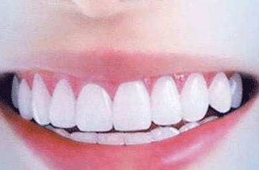 大人牙齿有洞怎么补牙