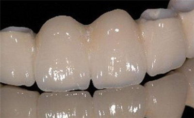 种植的牙齿可以用多少年(多少岁可以种植牙齿)