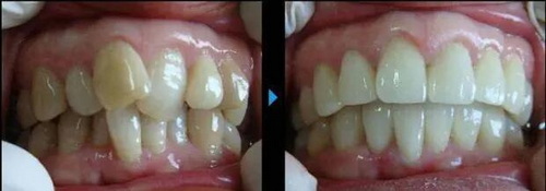 牙齿矫正后有没有遗症呢？