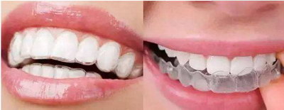 做的牙套一般能用多久(做的牙套一般能用多久)