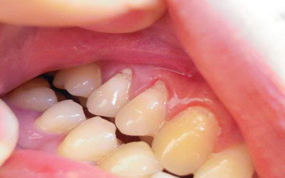 牙齿与牙龈边缘有黑色虚线