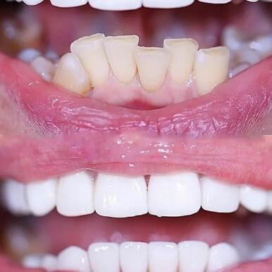全瓷牙没做好重做有伤害吗(全瓷牙重做是否会对口腔健康产生伤害？)