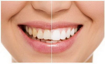 冷光美白牙所适合的牙齿种类呢？