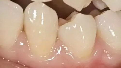 正常的牙齿之间有缝隙吗(正常牙齿之间缝隙多大)