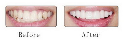 矫正牙齿多少费用有什么优势呢？