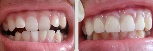 牙齿内侧的牙垢怎么去除(牙齿内侧上的牙垢怎么去除)