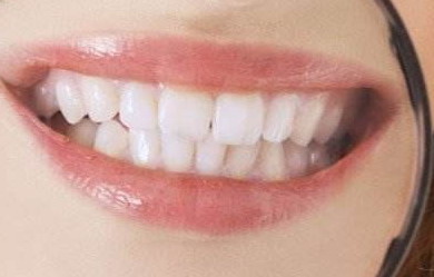 牙龈和牙齿有空隙