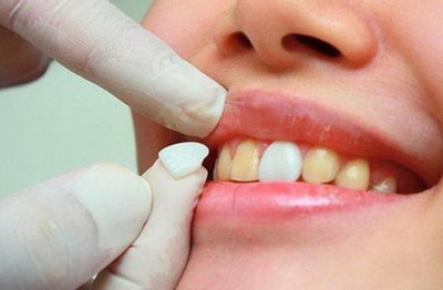 牙齿痛可以吃甲硝唑吗(牙齿痛可以吃甲硝唑和左氧吗)