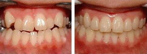 整牙多大年龄最好_整牙齿需要带多久牙套