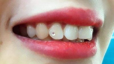 装全口假牙修复牙齿(修复牙齿方法之全口假牙)
