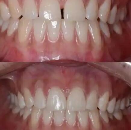 牙龈和牙床的区别(牙床和牙龈的区别)