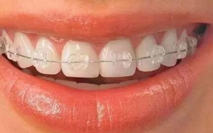 牙齿钙化怎么治疗(小孩牙齿钙化怎么治疗)