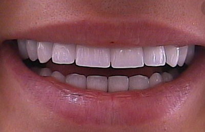 牙齿矫正后遗症能恢复吗