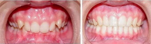 牙龈红肿可以做根管治疗