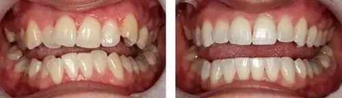 洗了牙以后牙齿容易黑了「牙齿贴片对以后牙齿有什么伤害」