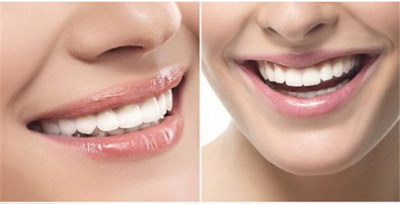 全瓷的牙齿可以用多久?