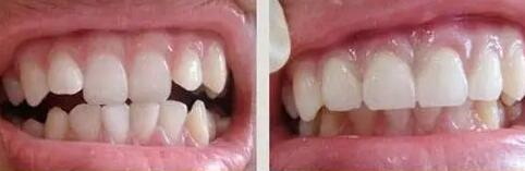 牙龈萎缩能种牙