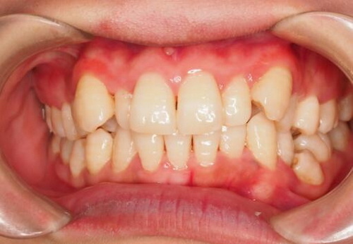 北京矫正牙齿可以报医保吗_十多岁矫正牙齿最好的方法