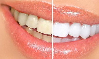 四环素牙齿是什么