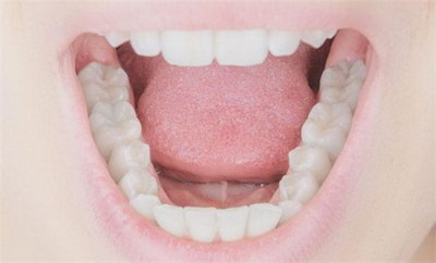 植牙安装牙冠的过程