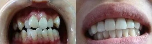牙龈萎缩后怎样才能长出来