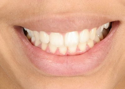 里面牙齿变黑(为什么会出现牙齿变黑的情况？)