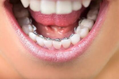 牙贴面有哪些材料_牙贴面可以洗牙吗
