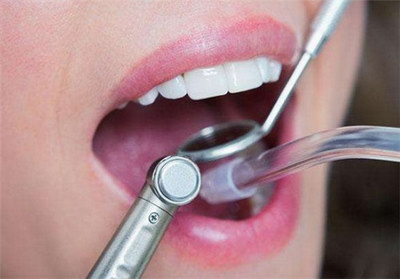 种植牙护理口腔(种植牙口腔护理)
