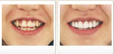 戴临时牙套的注意事项_戴了临时牙套为什么牙齿老是酸痛