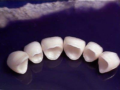 牙齿全口重建怎么做