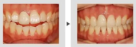 戴牙套牙龈萎缩恢复_戴牙套牙龈萎缩是大病前兆吗