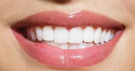 牙齿洞型制备分类