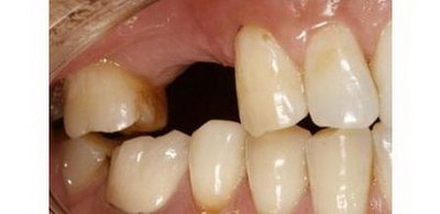 牙髓炎治疗方法第一步