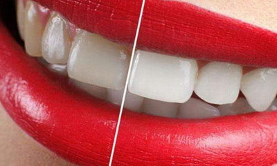 牙齿美白的缺点(牙齿美白适应症及优缺点)